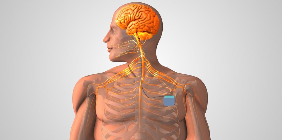 Vagus nerve: soon an implant against depression?
